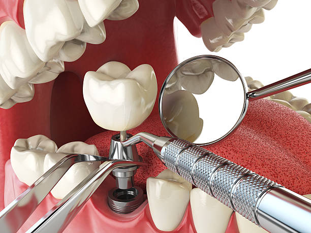 Best Emergency Root Canal Treatment in Newark, TX